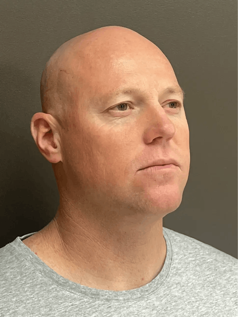 Full Face Rejuvenation Before & After Gallery - Patient 111243 - Image 3