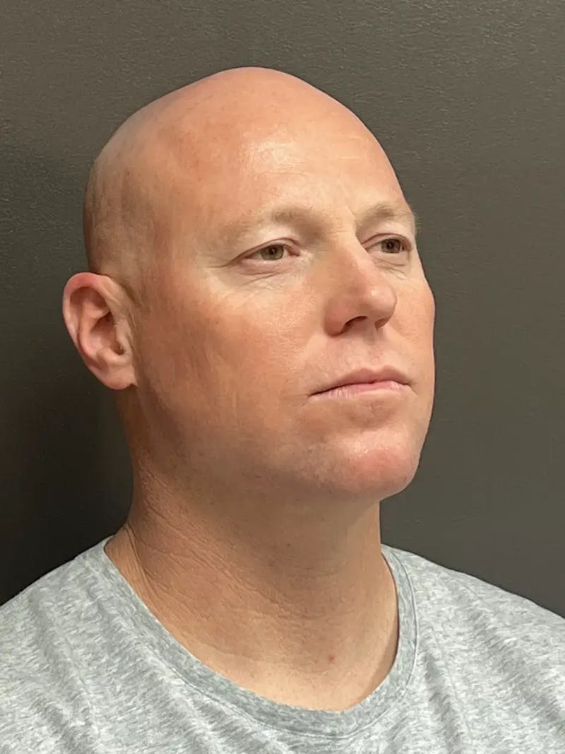 Full Face Rejuvenation Before & After Gallery - Patient 111243 - Image 4