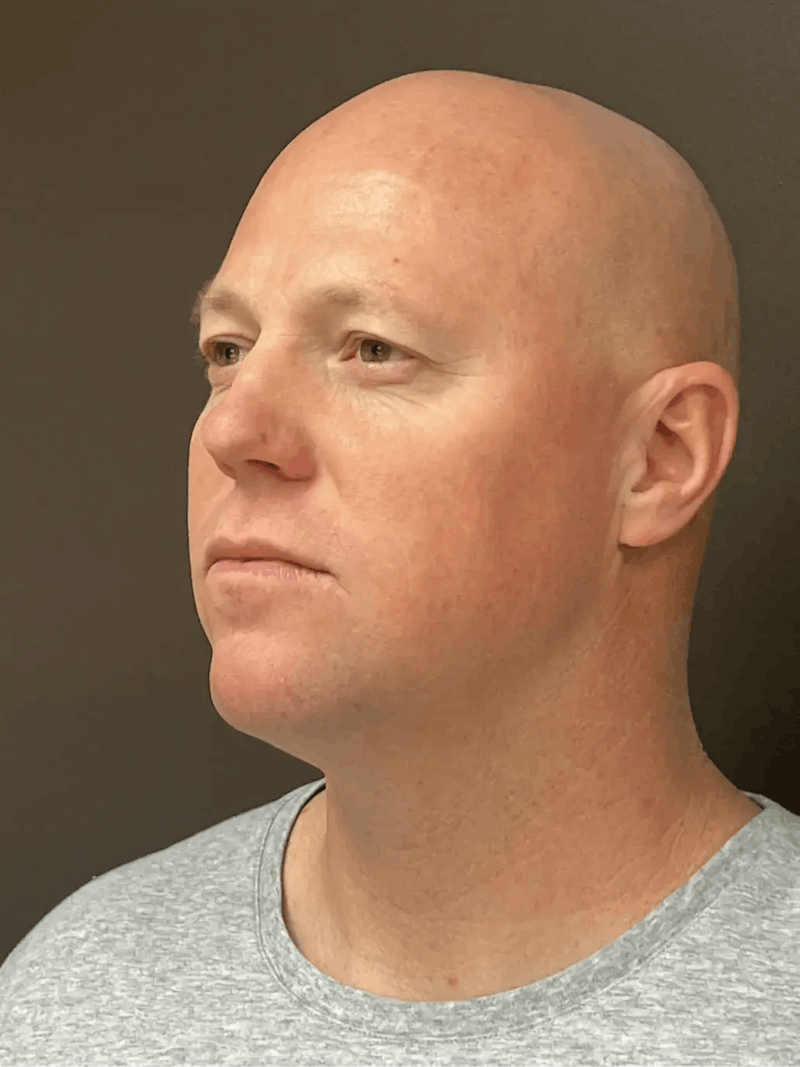 Full Face Rejuvenation Before & After Gallery - Patient 111243 - Image 5