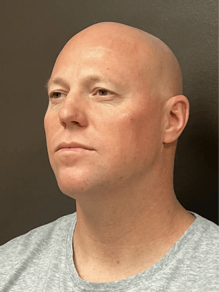 Full Face Rejuvenation Before & After Gallery - Patient 111243 - Image 6