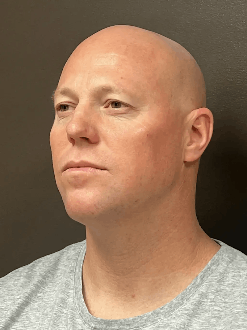 Full Face Rejuvenation Before & After Gallery - Patient 111243 - Image 6