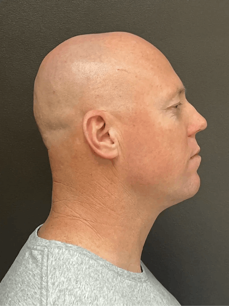 Full Face Rejuvenation Before & After Gallery - Patient 111243 - Image 7