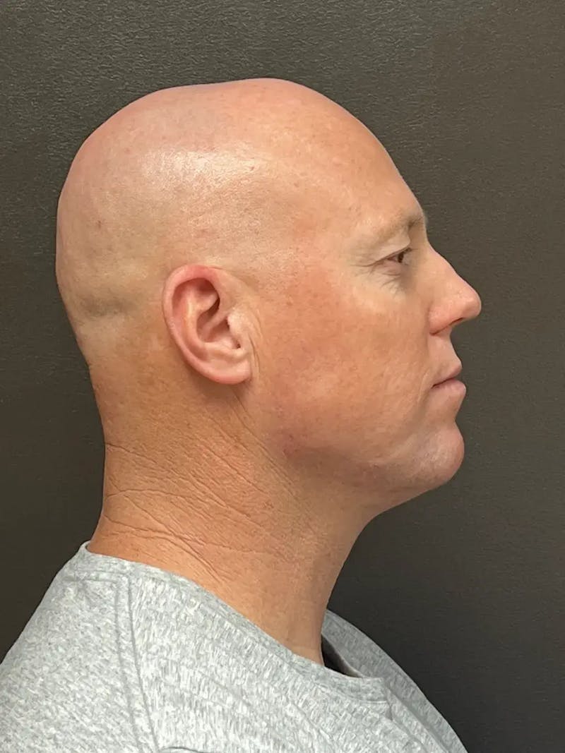 Full Face Rejuvenation Before & After Gallery - Patient 111243 - Image 8