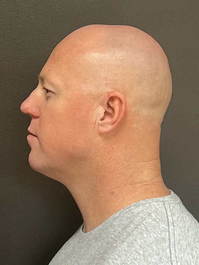 Full Face Rejuvenation Before & After Gallery - Patient 111243 - Image 9