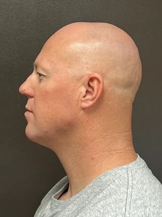 Full Face Rejuvenation Before & After Gallery - Patient 111243 - Image 10