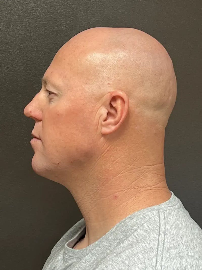 Full Face Rejuvenation Before & After Gallery - Patient 111243 - Image 10