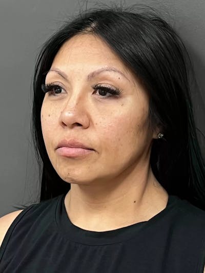 Full Face Rejuvenation Before & After Gallery - Patient 281621 - Image 1