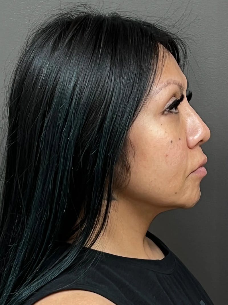 Full Face Rejuvenation Before & After Gallery - Patient 281621 - Image 3