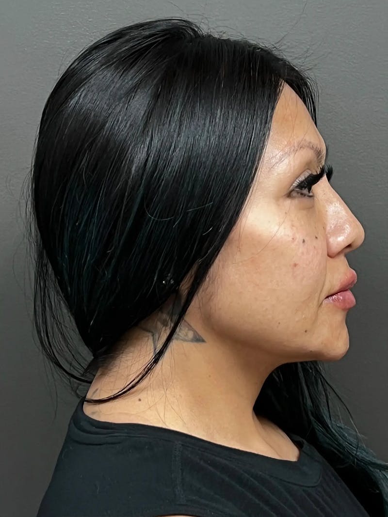 Full Face Rejuvenation Before & After Gallery - Patient 281621 - Image 4