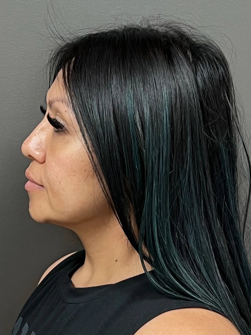 Full Face Rejuvenation Before & After Gallery - Patient 281621 - Image 5