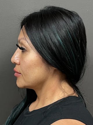 Full Face Rejuvenation Before & After Gallery - Patient 281621 - Image 6