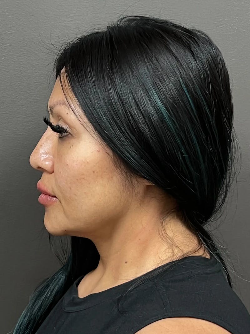 Full Face Rejuvenation Before & After Gallery - Patient 281621 - Image 6