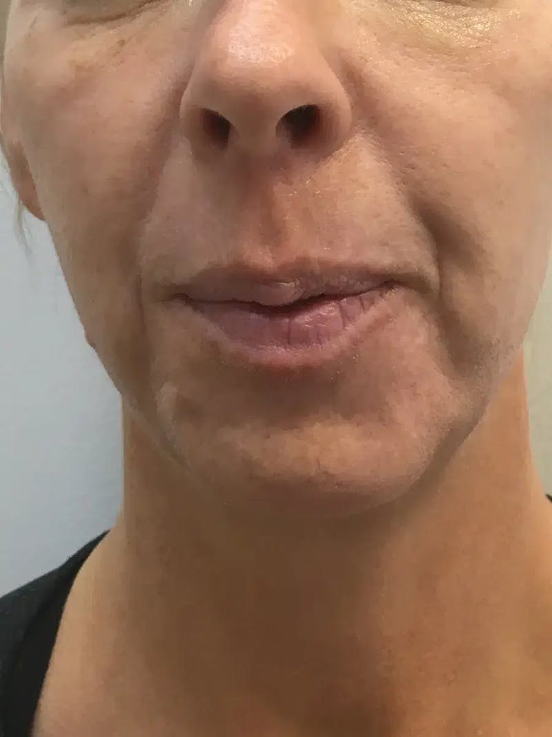 Chin Filler Before & After Gallery - Patient 239941 - Image 1