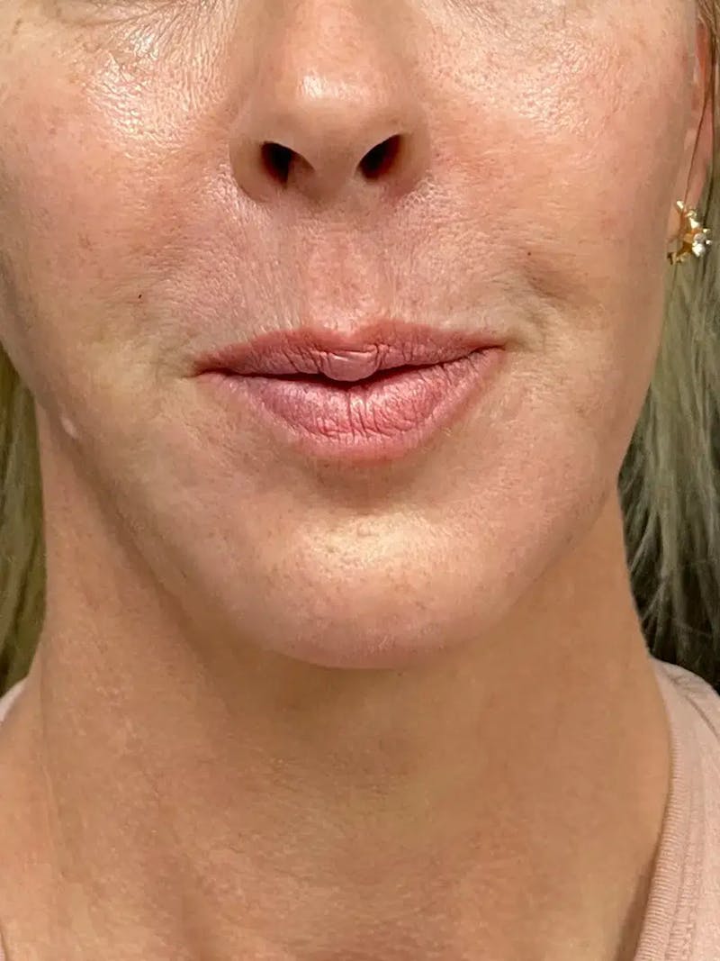 Chin Filler Before & After Gallery - Patient 239941 - Image 2