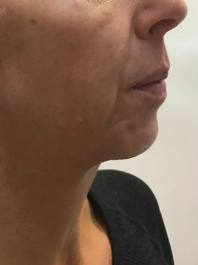 Chin Filler Before & After Gallery - Patient 239941 - Image 3