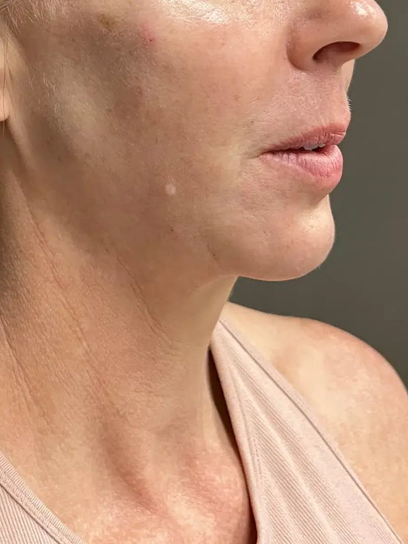 Chin Filler Before & After Gallery - Patient 239941 - Image 4