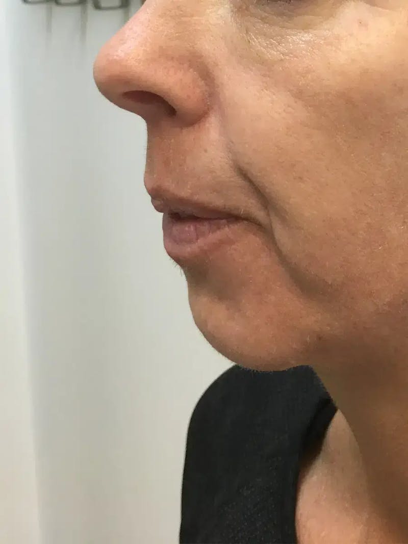 Chin Filler Before & After Gallery - Patient 239941 - Image 5