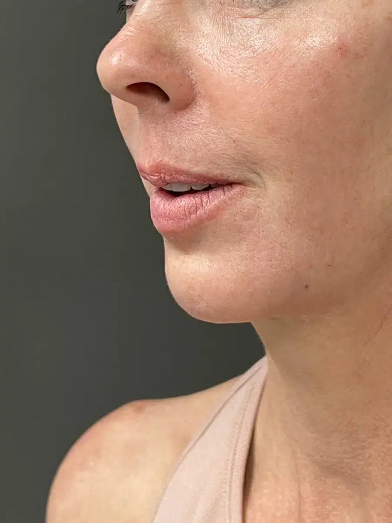 Chin Filler Before & After Gallery - Patient 239941 - Image 6