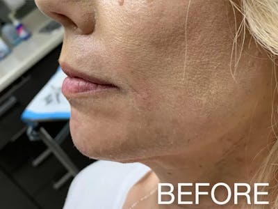 Chin Filler Before & After Gallery - Patient 357748 - Image 1