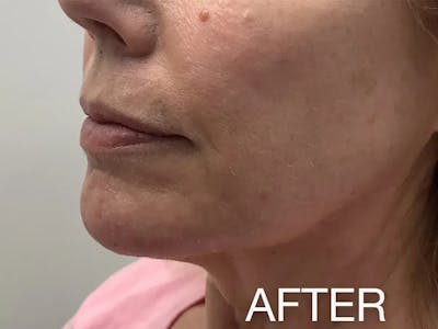 Chin Filler Before & After Gallery - Patient 357748 - Image 2