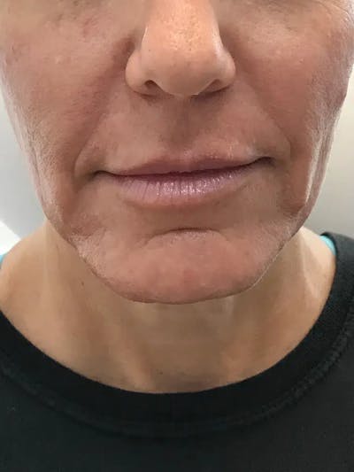 Chin Filler Before & After Gallery - Patient 352475 - Image 1