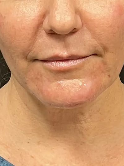 Chin Filler Before & After Gallery - Patient 352475 - Image 2