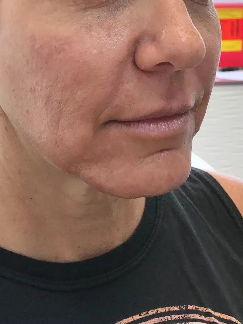 Chin Filler Before & After Gallery - Patient 352475 - Image 3