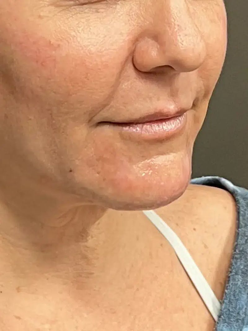 Chin Filler Before & After Gallery - Patient 352475 - Image 4