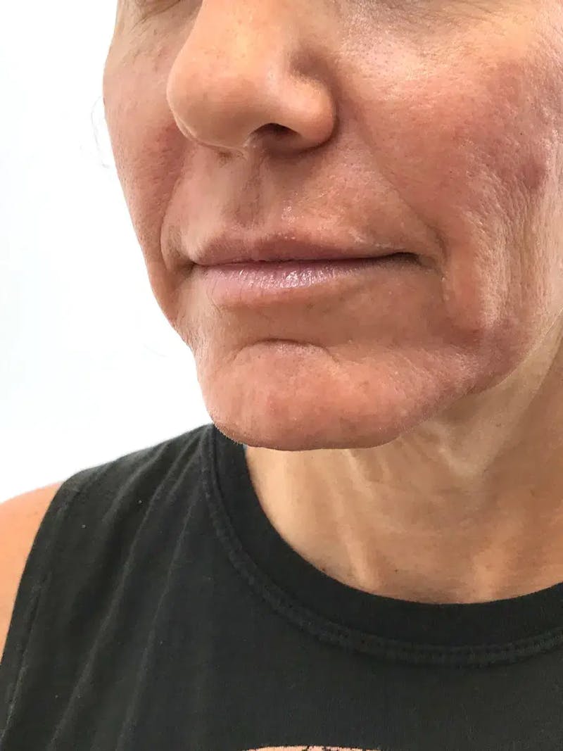 Chin Filler Before & After Gallery - Patient 352475 - Image 5