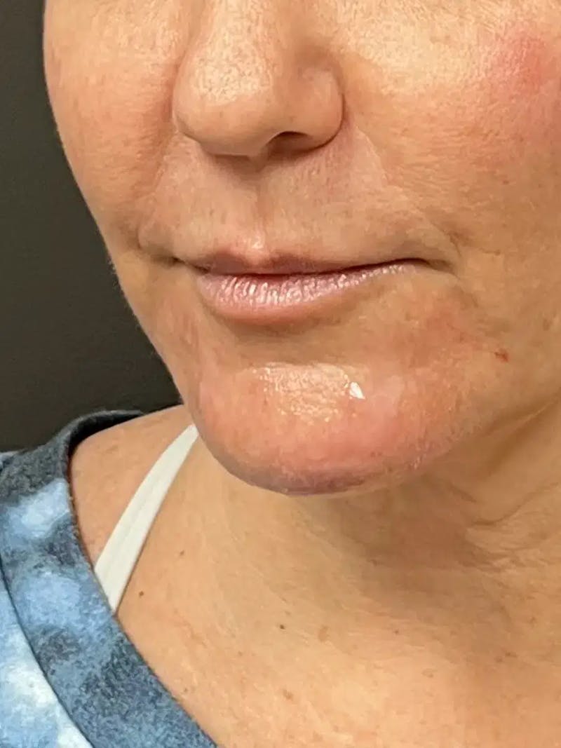 Chin Filler Before & After Gallery - Patient 352475 - Image 6