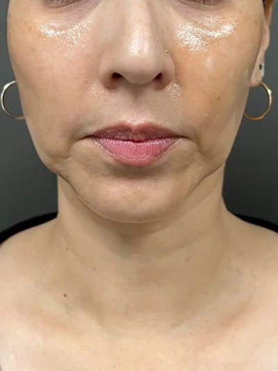 Chin Filler Before & After Gallery - Patient 369943 - Image 1