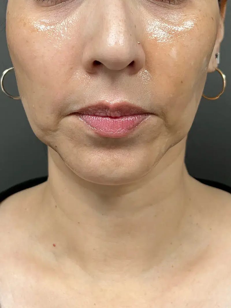 Chin Filler Before & After Gallery - Patient 369943 - Image 1