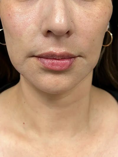 Chin Filler Before & After Gallery - Patient 369943 - Image 2