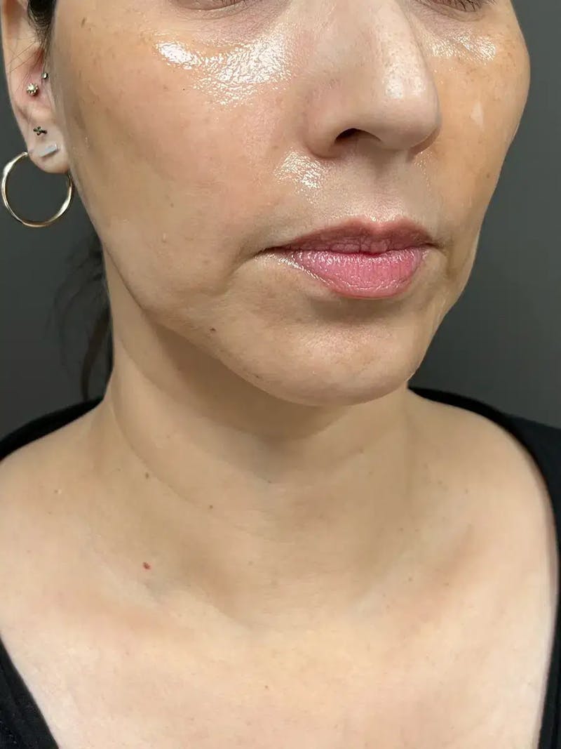 Chin Filler Before & After Gallery - Patient 369943 - Image 3
