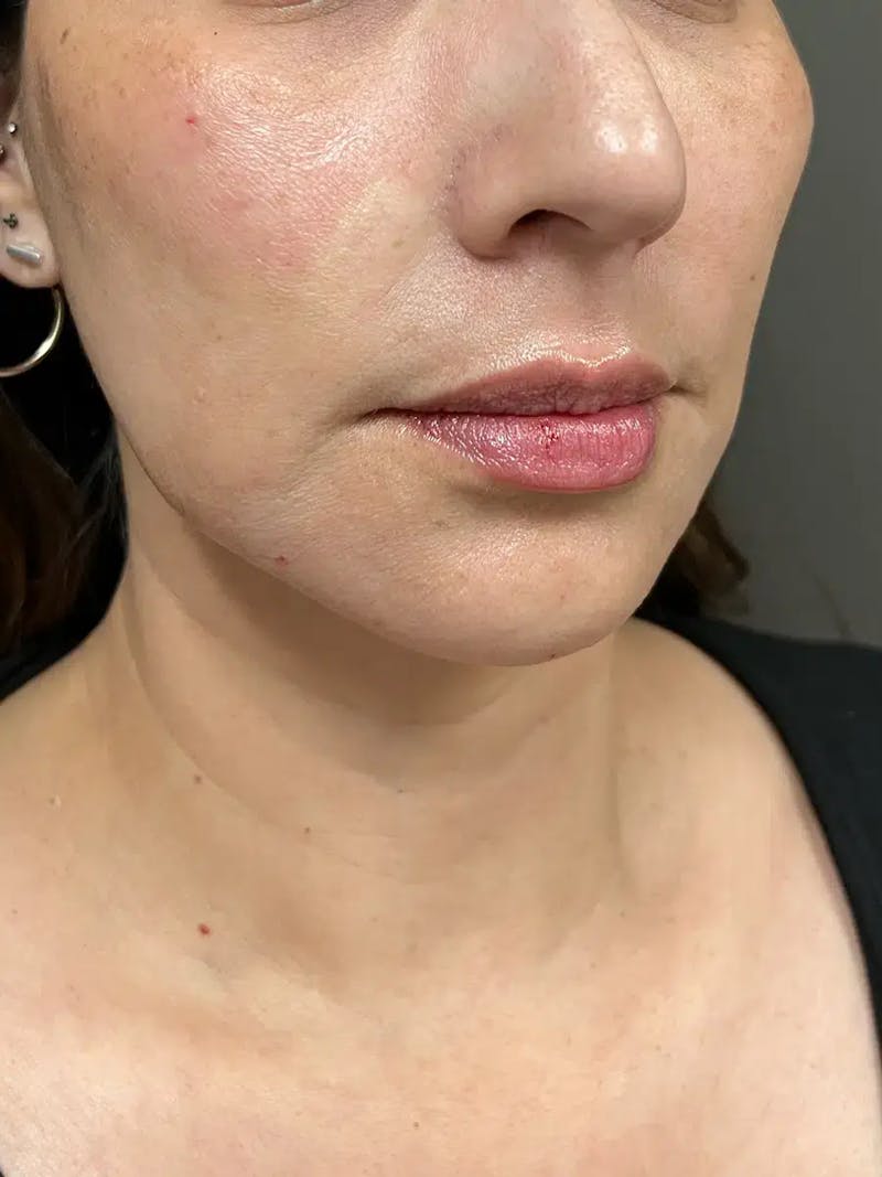 Chin Filler Before & After Gallery - Patient 369943 - Image 4