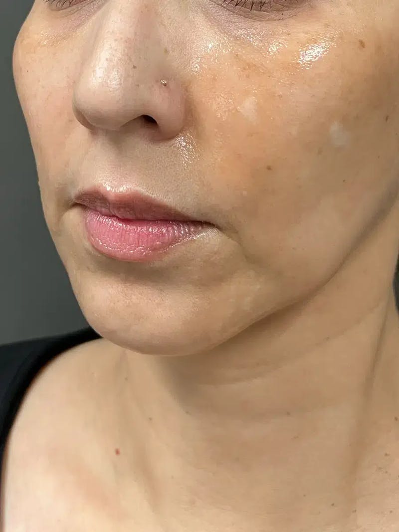 Chin Filler Before & After Gallery - Patient 369943 - Image 5