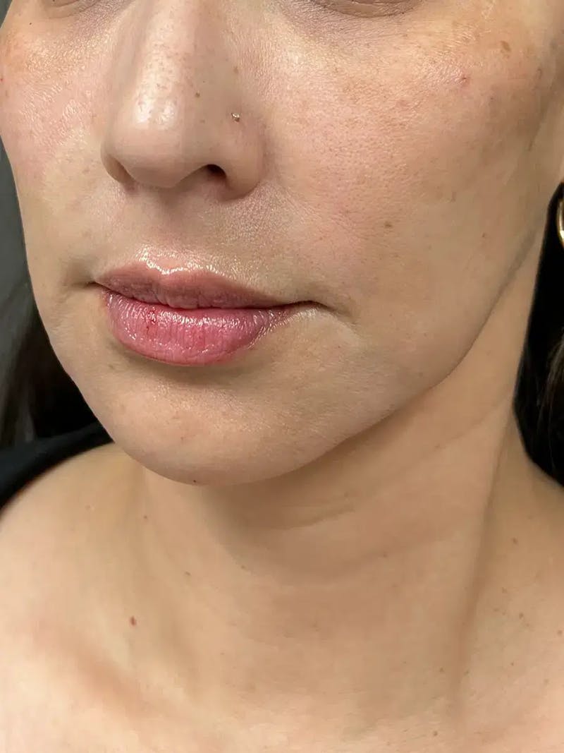 Chin Filler Before & After Gallery - Patient 369943 - Image 6