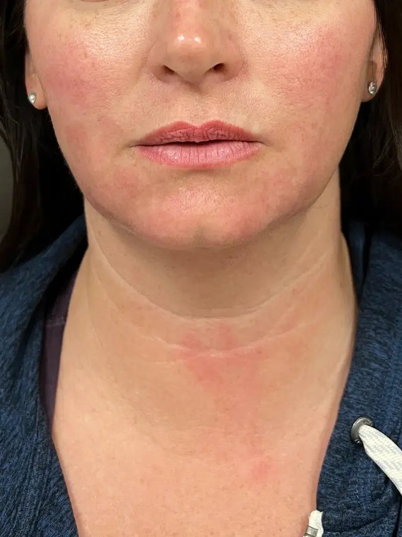 Chin Filler Before & After Gallery - Patient 214723 - Image 1