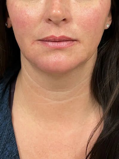 Chin Filler Before & After Gallery - Patient 214723 - Image 2