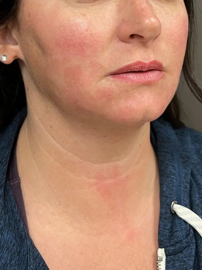 Chin Filler Before & After Gallery - Patient 214723 - Image 3