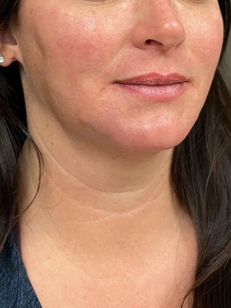 Chin Filler Before & After Gallery - Patient 214723 - Image 4