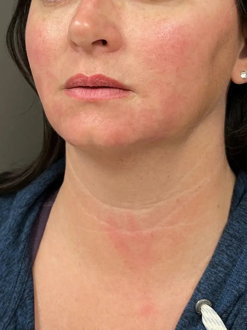 Chin Filler Before & After Gallery - Patient 214723 - Image 5