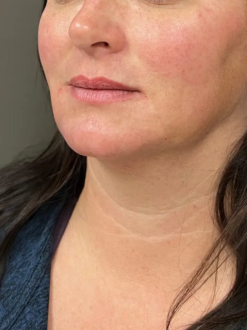 Chin Filler Before & After Gallery - Patient 214723 - Image 6