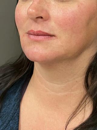 Chin Filler Before & After Gallery - Patient 214723 - Image 6