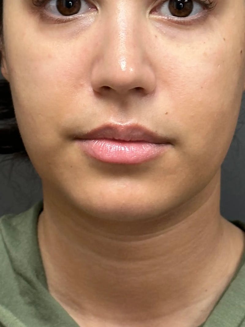 Chin Filler Before & After Gallery - Patient 111130 - Image 1