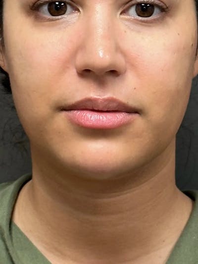 Chin Filler Before & After Gallery - Patient 111130 - Image 2