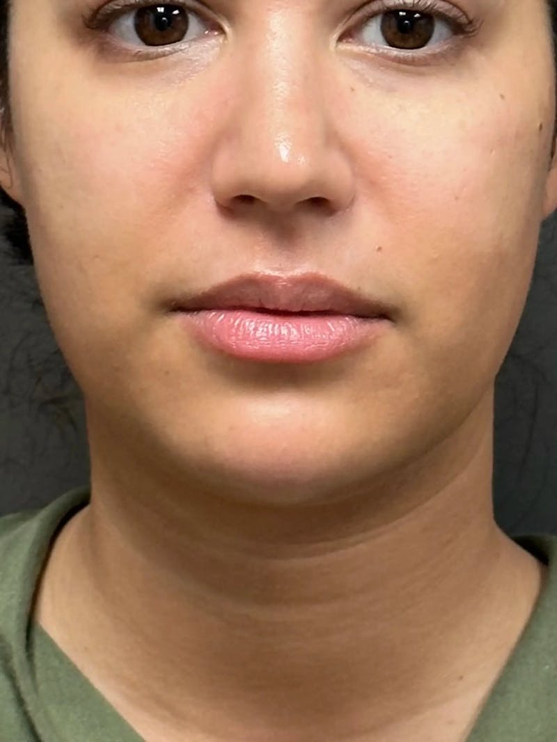 Chin Filler Before & After Gallery - Patient 111130 - Image 2
