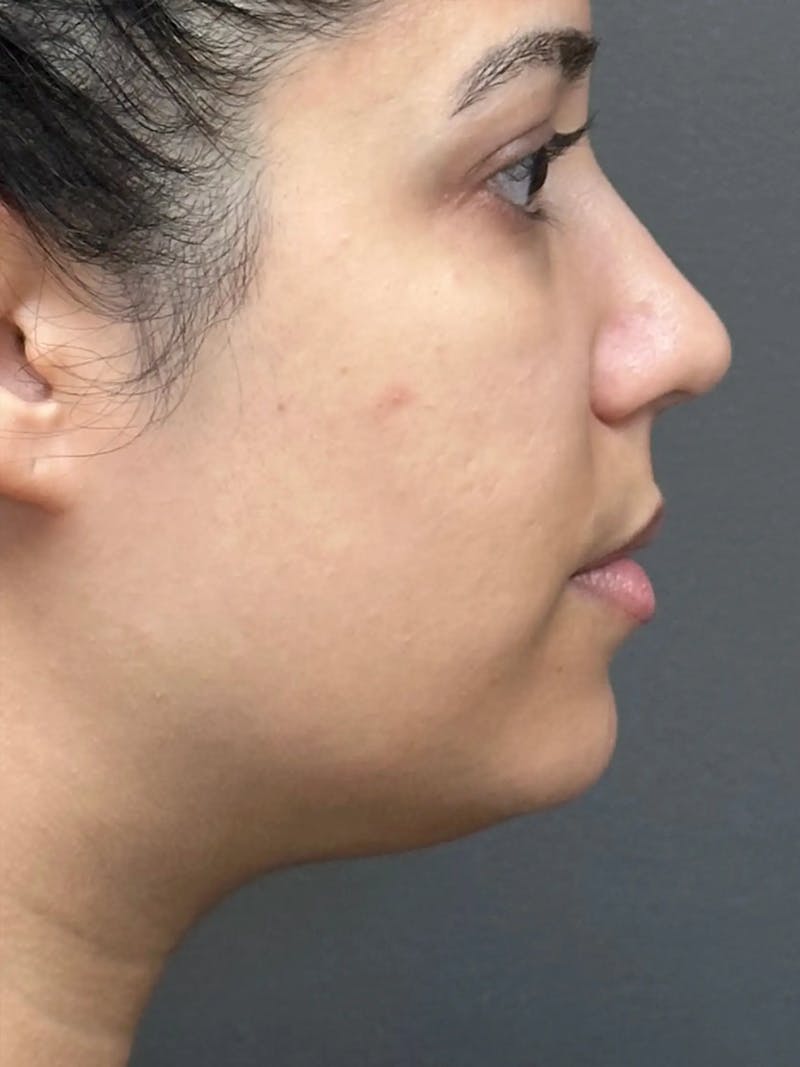Chin Filler Before & After Gallery - Patient 111130 - Image 3
