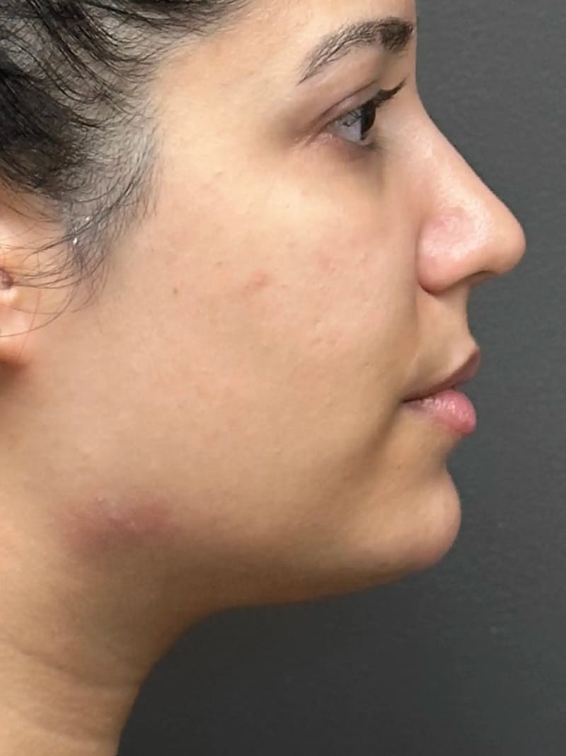 Chin Filler Before & After Gallery - Patient 111130 - Image 4