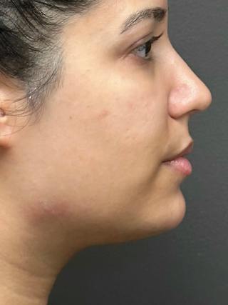 Chin Filler Before & After Gallery - Patient 111130 - Image 4